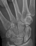 X-ray image 6 months after surgery