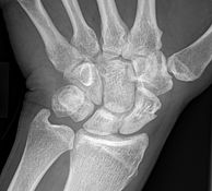 X-ray image Scaphoid post-op. after 18 months